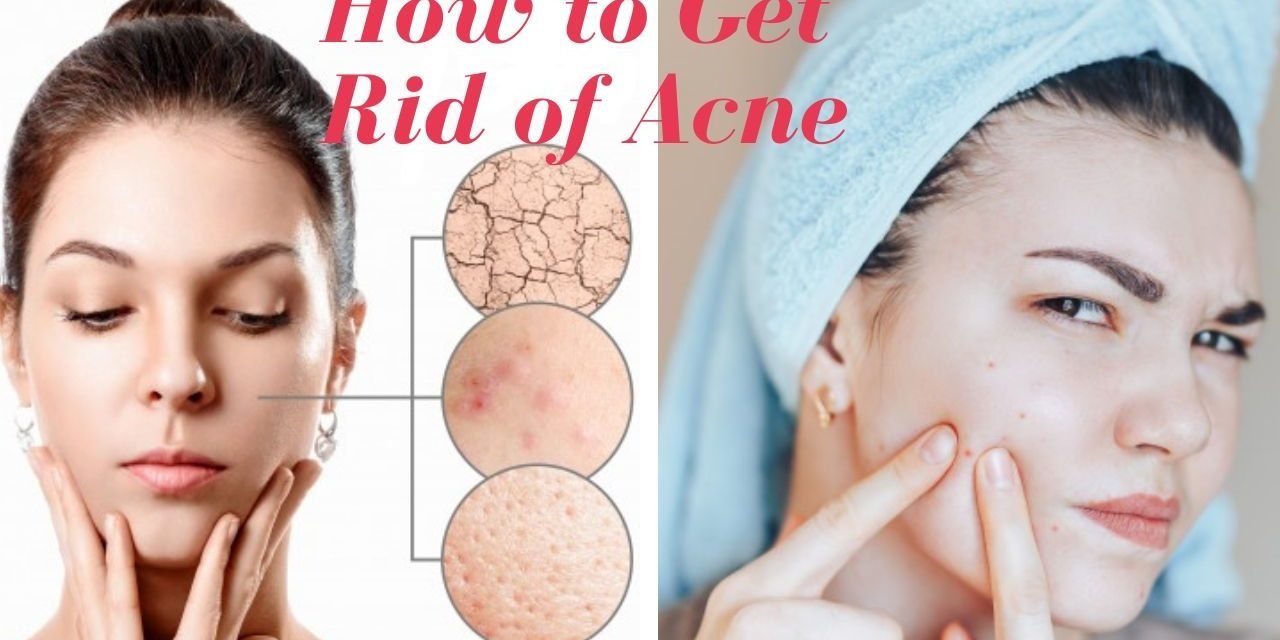 11 Natural Ways to Get Rid of Acne Fast