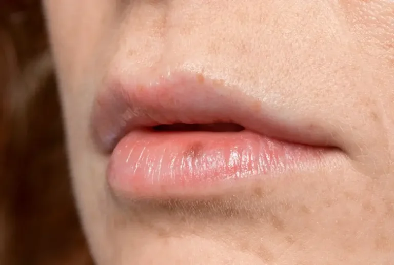 Close-up of swollen lips, focusing on how to get rid of swollen lips fast