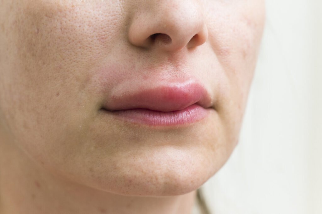 Swelling of Lips